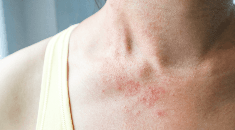 Histamine Reactions in Sensitive Individuals